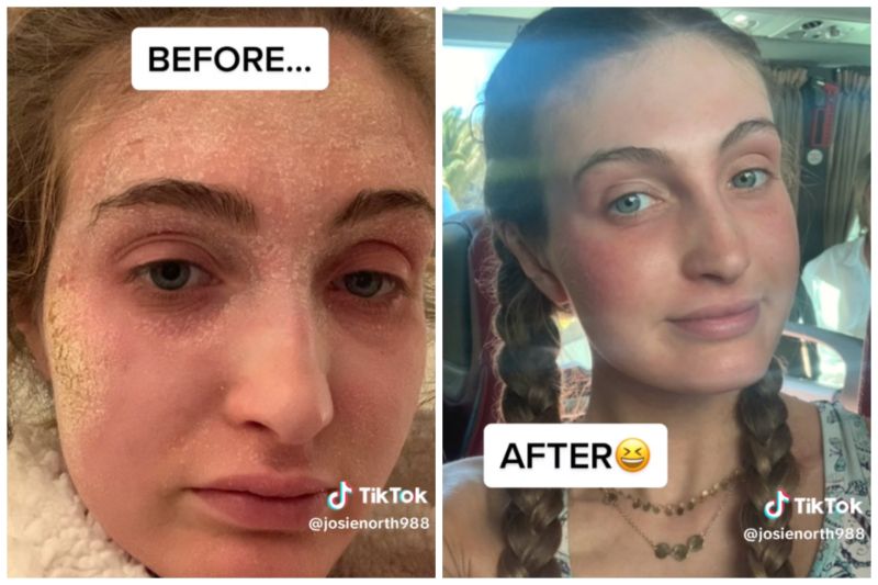 face fillers