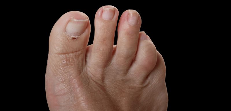 foot pain