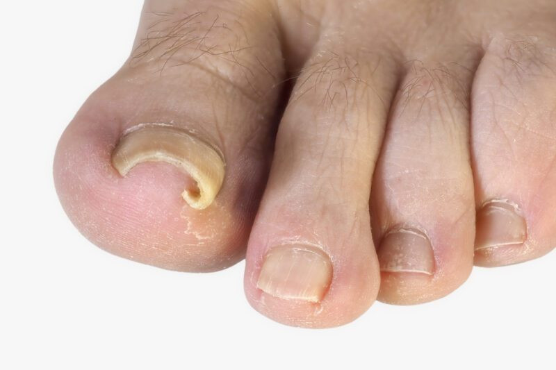 distal phalanx