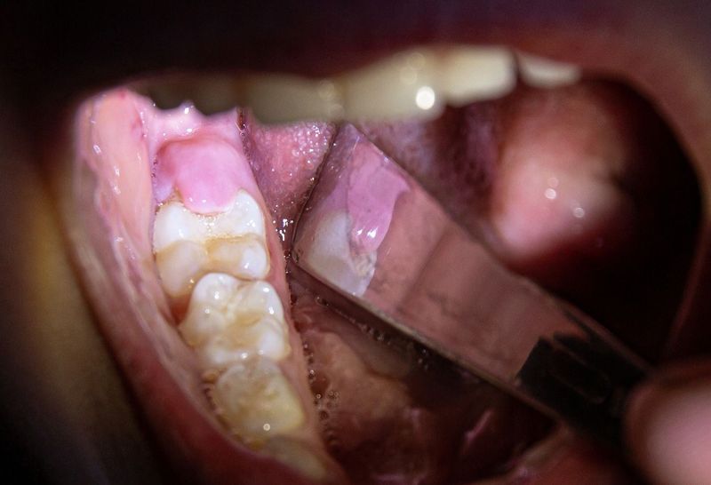 teeth growing from side of gum