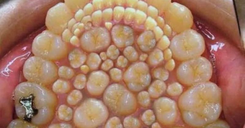 bumps on gums under teeth