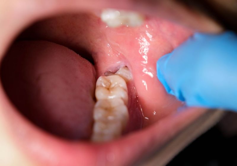 bottom teeth receding gums