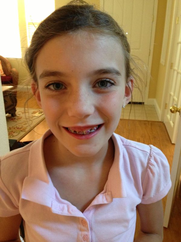 sarah reasons braces off